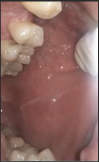 1 Month After — healed cheek