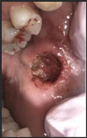 During — laser fibroma removal