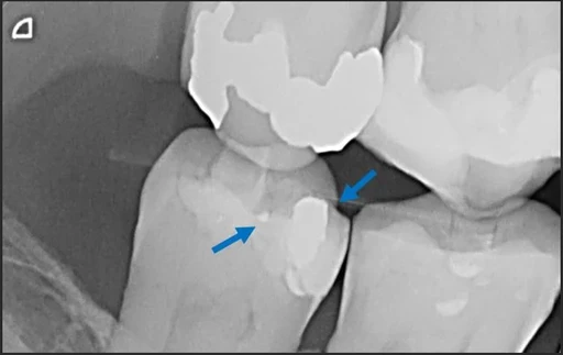 X-ray showing residual amalgam