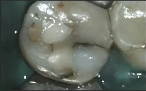 Before — right view