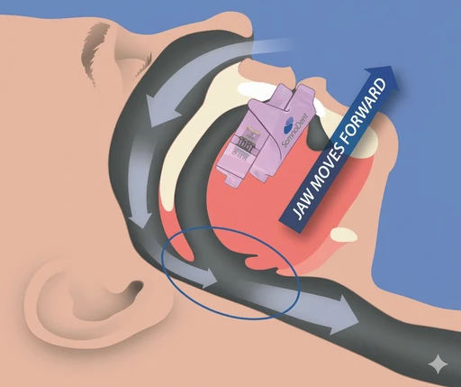Diagram showing jaw advancing forward during sleep to open airway