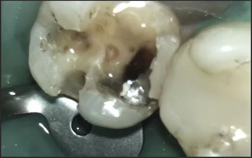 During SMART amalgam removal