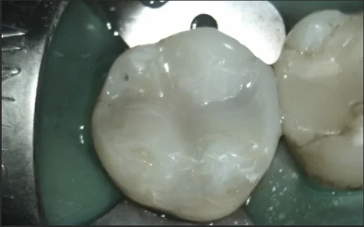 After composite resin restoration