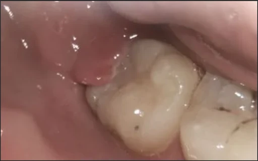 Before — gum over wisdom tooth
