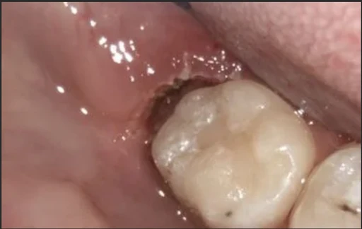 During — laser gum removal