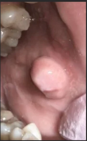 Before — fibroma on cheek