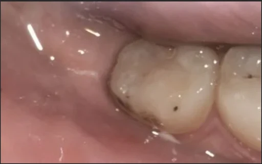 1 Month After — healed gum